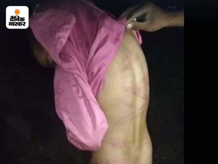 टीचर की पिटाई से बच्चे के शरीर पर निशान उभर आए थे।