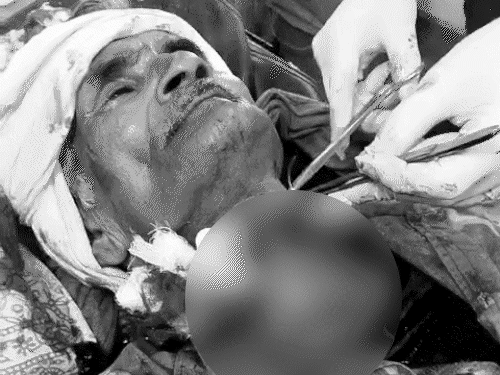 चाइनीज मांझे से बुजुर्ग का गला कट गया। गर्दन पर 15 टांके आए हैं। - Dainik Bhaskar