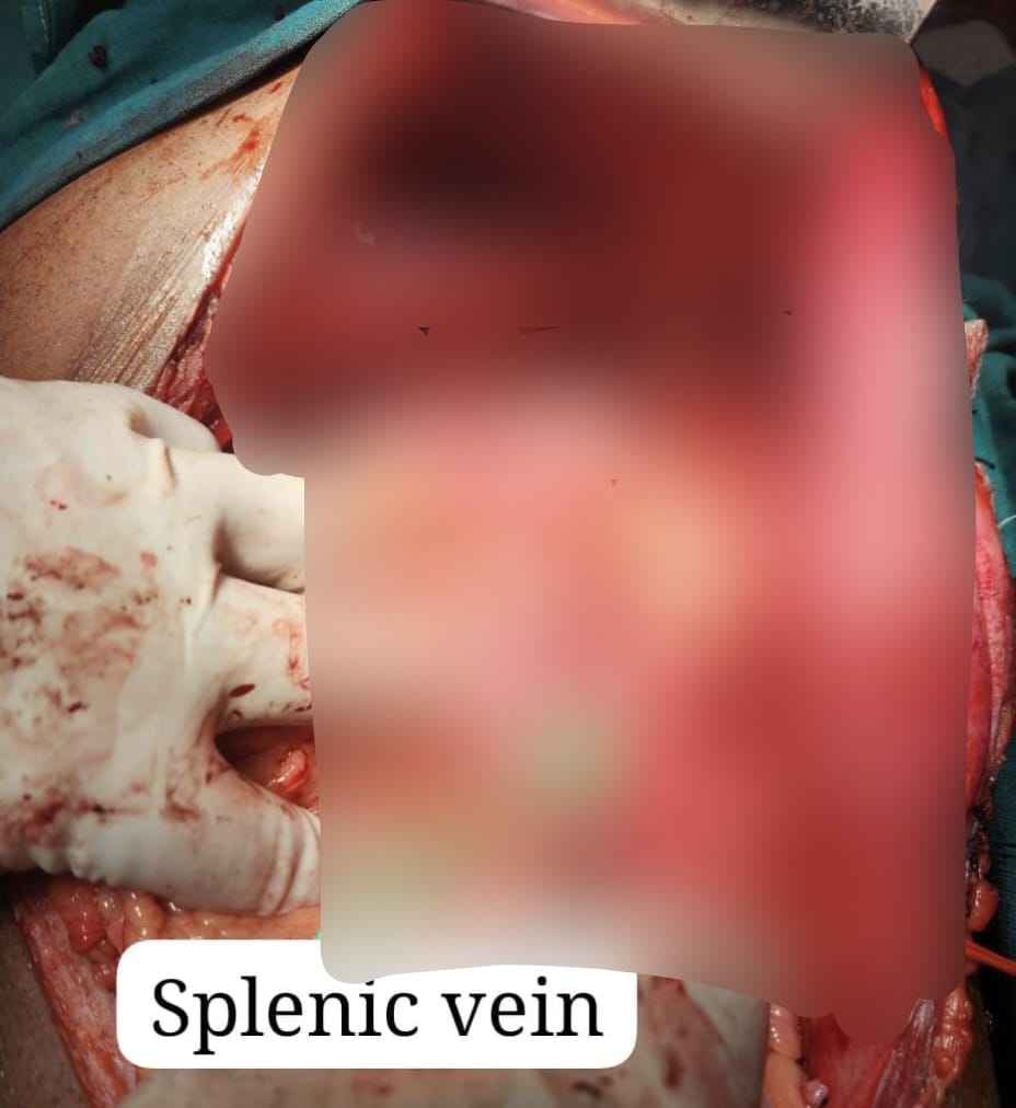 First shunt surgery done in SNMC | आगरा के SNMC में हुई पहली शंट सर्जरी ...