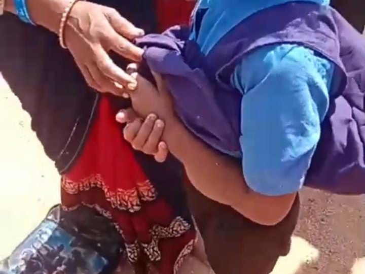 छज्जा गिरने के कारण बच्ची का हाथ टूटा