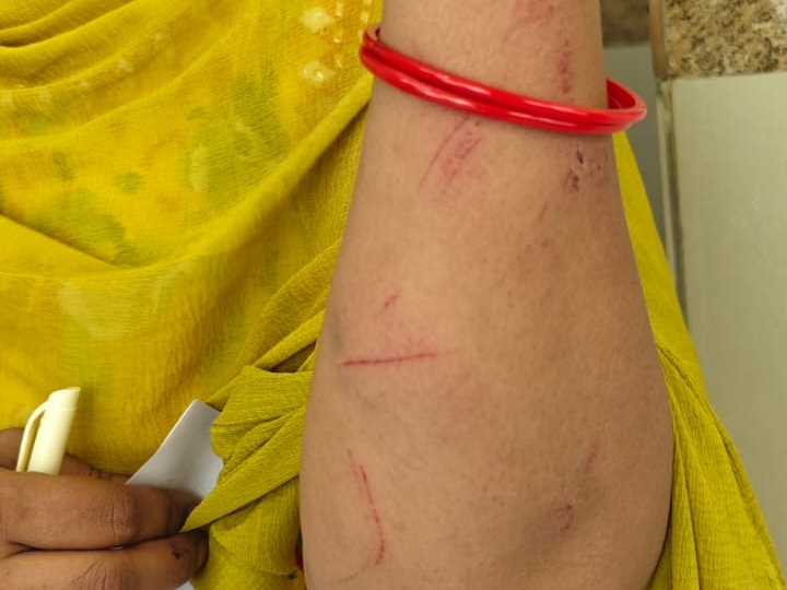 घायल फिजियोथेरिपिस्ट डॉ ज्योतिमाला बंजारे अपनी चोट दिखाती हुईं।