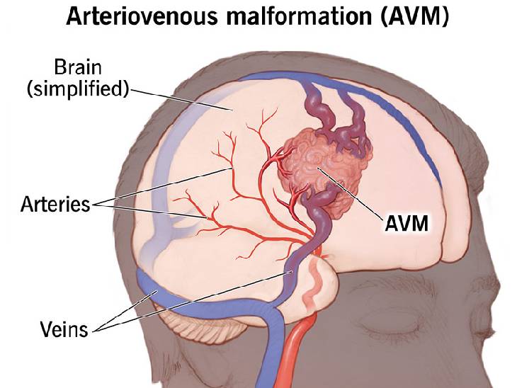 Avm Child noida The child got a new life after 6 hours of major surgery The child ...