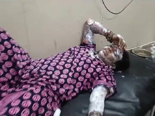 महिला की साड़ी में आग पकड़ लेने ने वो बुरी तरह जल गई। दुर्घटना में महिला 70 प्रतिशत से अधिक झुलस गई।
