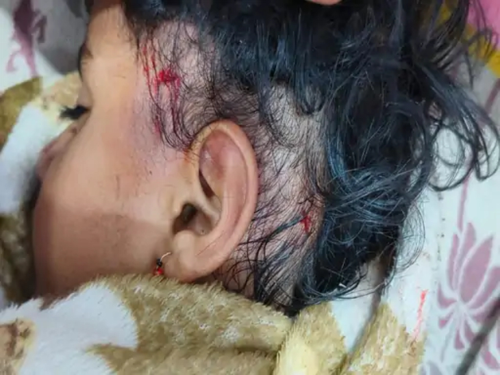 नवंबर 2023 में रायपुर के रामनगर इलाके में कुत्तों ने ढाई साल की बच्ची को नोंच दिया था।