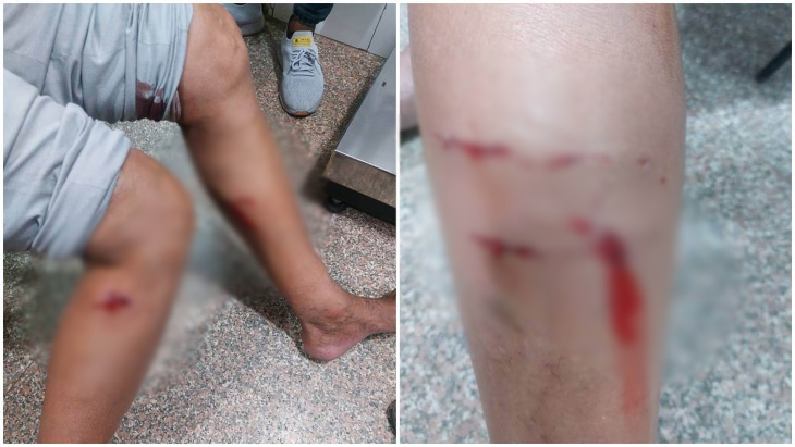 बच्ची को नोंचने की घटना के 5 दिन बाद ही कटोरा तालाब में भी कुत्तों ने एक डॉक्टर को काटा था।