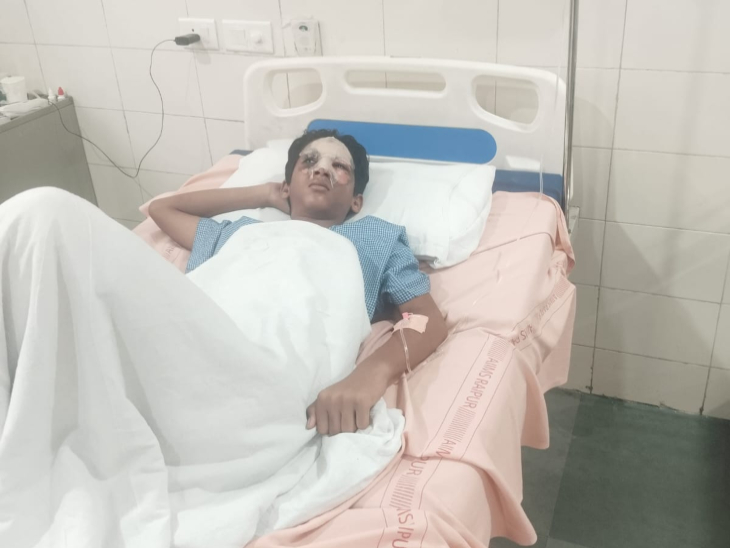 रायपुर में शनिवार को 12 साल के बच्चे पर पाउडर फेंकने से उसका चेहरा झुलस गया।