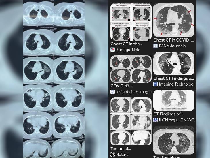 पहली तस्वीर दो साल पहले की कोरोना संक्रमित मरीज की है। दूसरी सीटी स्कैन इमेज अभी के मरीज की है।