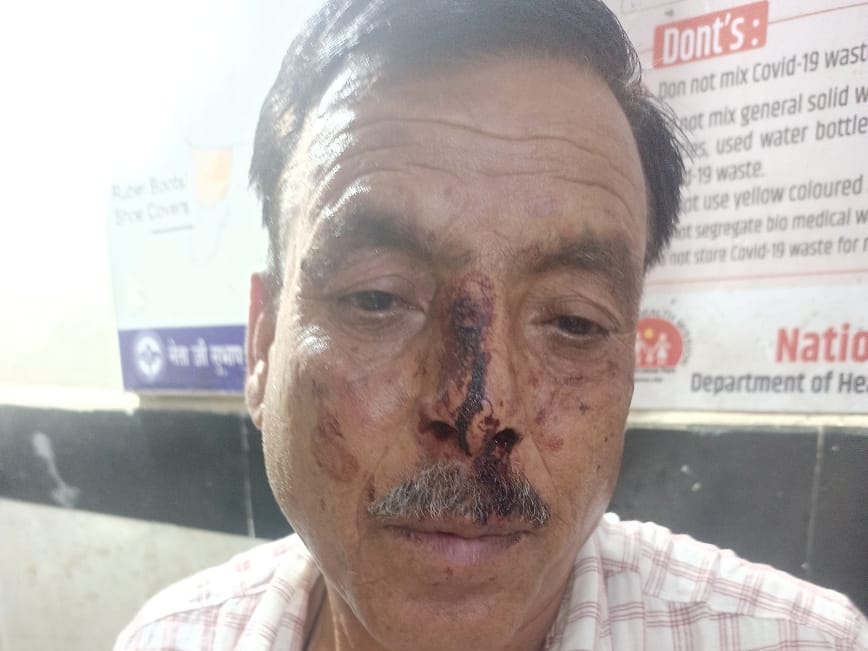 क्रशर मालिक द्वारा मारपीट के बाद नेत्र सिंह के नाक पर चोट के निशान