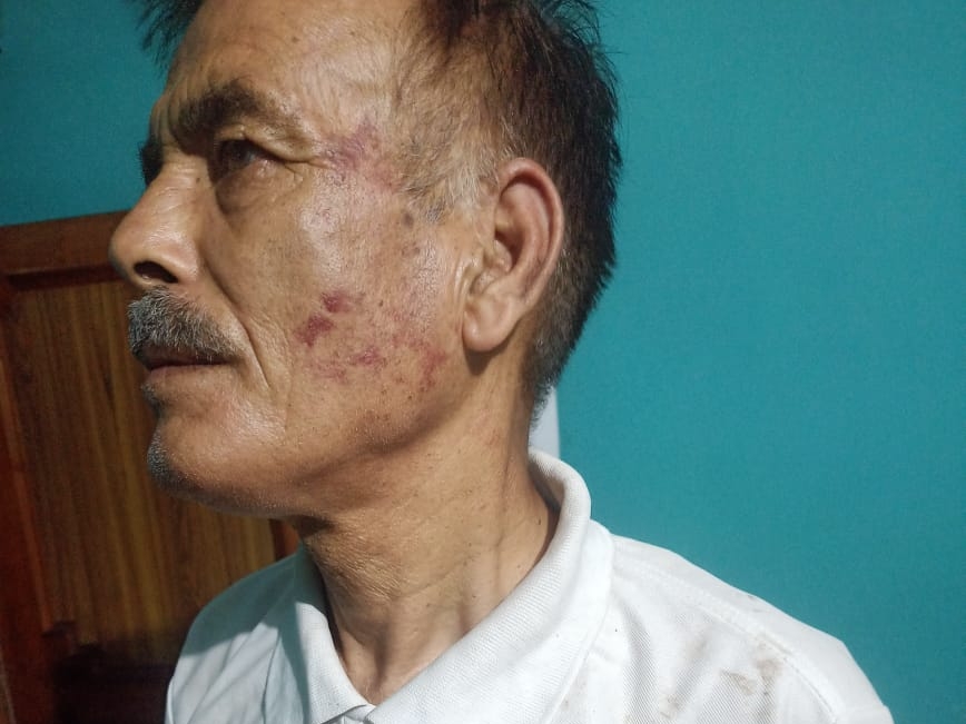 रिटायर फौजी नेत्र सिंह के चेहरे पर मारपीट के बाद चोट के निशान