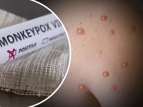 भारत में मंकीपॉक्स का पहला मामला हरियाणा में मिला था। दो मरीज केरल में मिले हैं। - Dainik Bhaskar