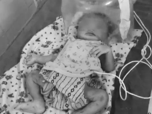 सुरेंद्रनगर के गांधी अस्पताल में एडमिट बच्ची।