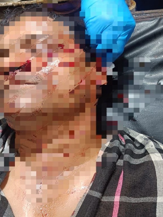 बेटे ने पिता का कटर से काट डाला पूरा चेहरा।