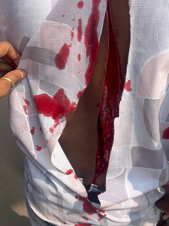 इस तरह लड़के की पीठ पर चलाया कटर