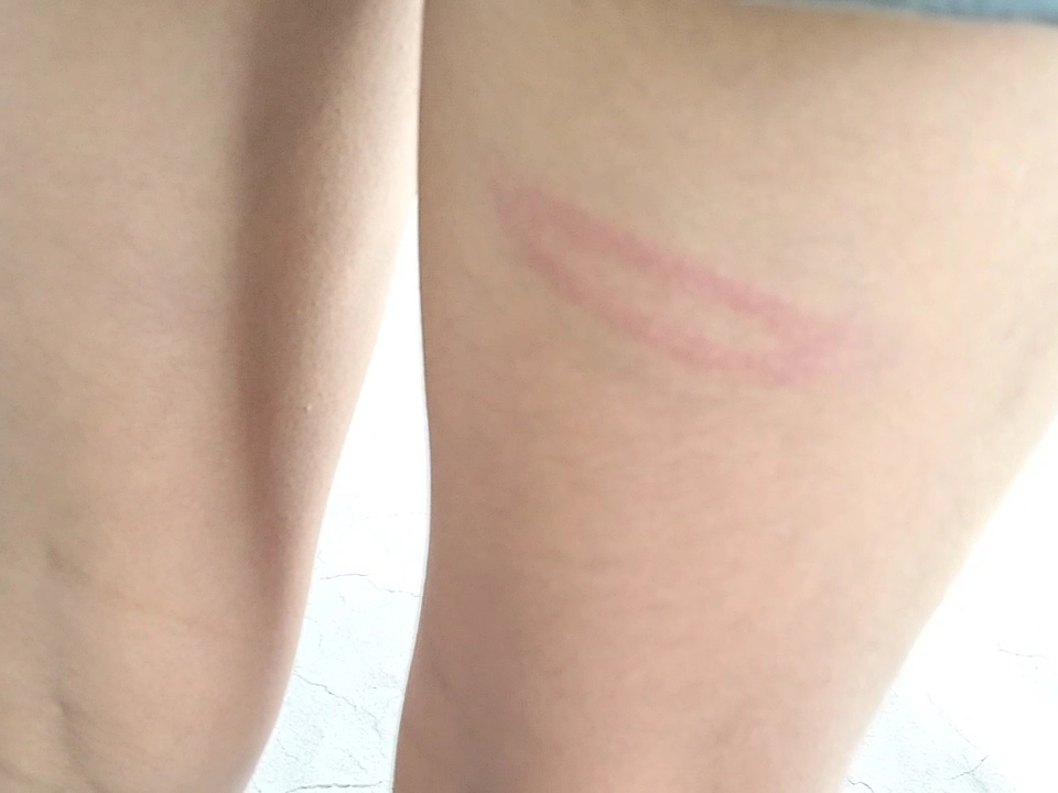 शिक्षक ने की 7वीं के छात्र की पिटाई, पैर पर जख्म के निशान।