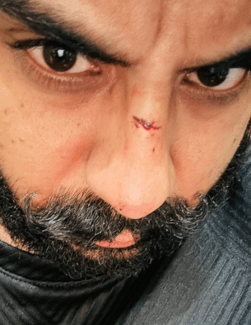 इस हादसे में अपिंद्रपाल को नाक पर, उनकी पत्नी को होंठ पर और बेटी को आंख के पास चोट आई थी।