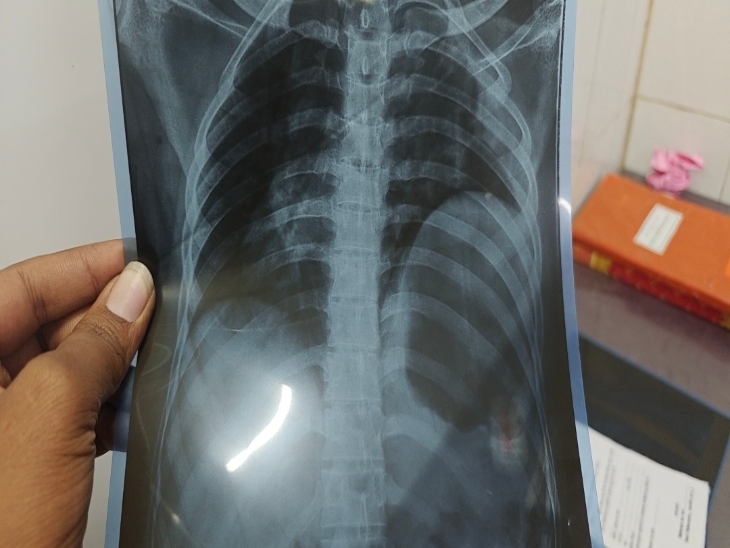 साहिल पटेल ने बीच-बचाव की कोशिश की तो उस पर भी चाकू से वार किया गया।