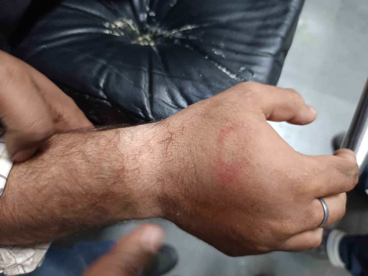 रोहित के हाथ में लगी चोट।