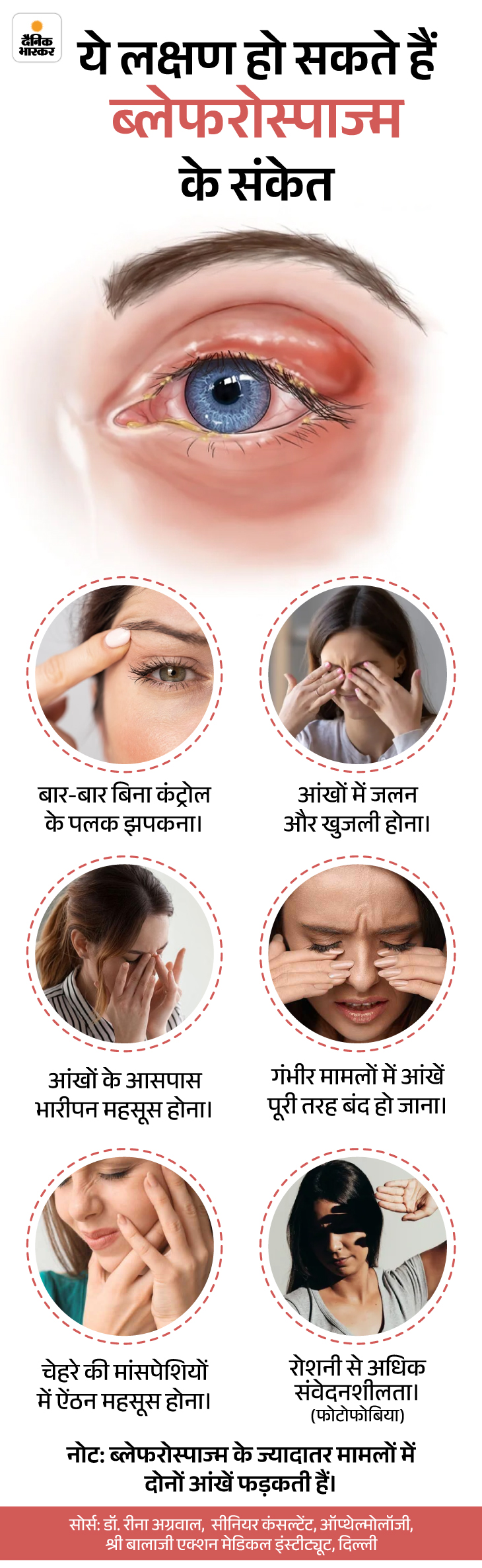 Twitching eyelid reasons; Blepharospasm symptoms & causes explained | Sehthanama- Eye flare can not just fatigue, disease can be: Blaphrospasm will end control on the muscles of the eyes, learn from the doctor to treat and prevent the treatment 10 sehatnama19th march slide2 1742301180 -