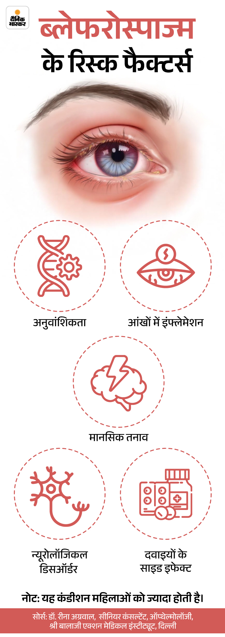 Twitching eyelid reasons; Blepharospasm symptoms & causes explained | Sehthanama- Eye flare can not just fatigue, disease can be: Blaphrospasm will end control on the muscles of the eyes, learn from the doctor to treat and prevent the treatment 11 sehatnama19th march slide3 1742301202 -