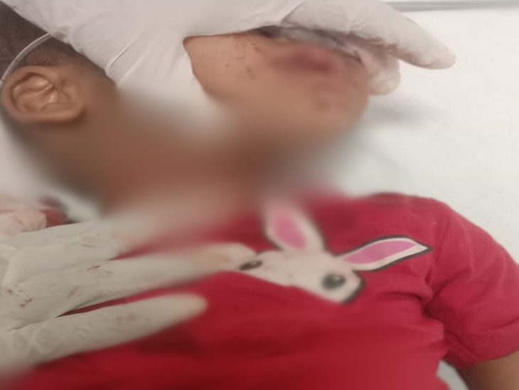 1 साल का शिवम गंभीर रूप से घायल है।