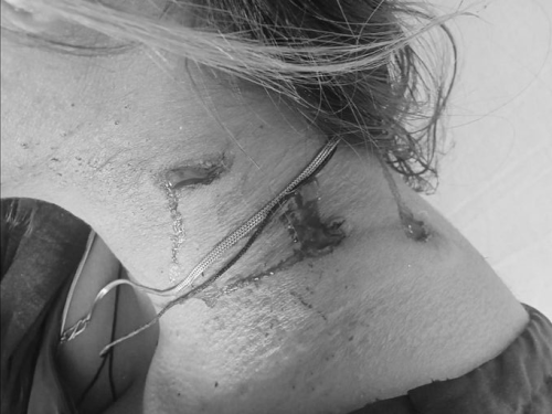 ਬਿ bea ਟੀ ਦੇ ਗਲੇ ਤੇ ਛੋਟੇ ਨਿਸ਼ਾਨ ਦਿਖਾਈ ਦਿੰਦੇ ਹਨ.