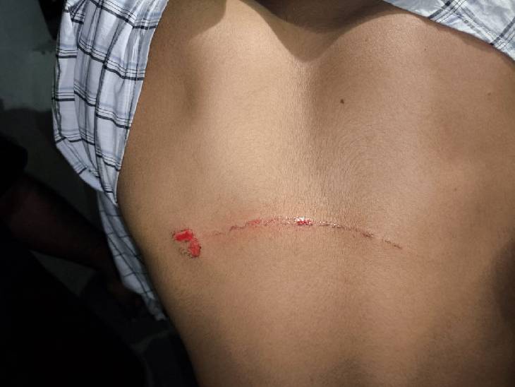 ਇੱਕ ਵਿਦਿਆਰਥੀ ਦੇ ਪਿਛਲੇ ਪਾਸੇ ਇੱਕ ਸਾਬਰ ਦੇ ਨਿਸ਼ਾਨ.