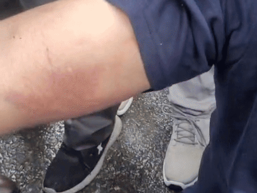 ਸੱਟ ਲੱਗਣ ਵਾਲੇ ਐਨਐਚਐਮ ਦੇ ਕਰਮਚਾਰੀ.