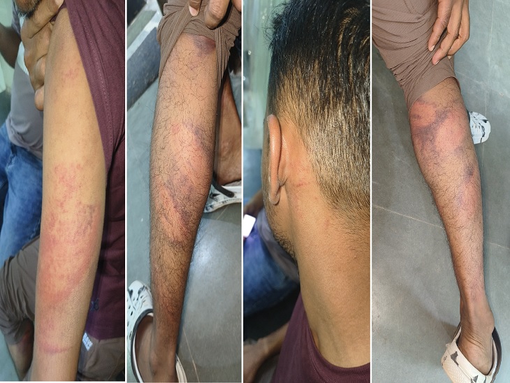 महिर ने दिखाई अपनी चोट कहा पुलिस ने किया थर्ड डिग्री का इस्तेमाल