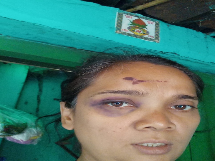 महिला के माथे के बाएं हिस्से में चोटें आई हैं।