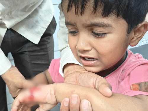 कुत्ते के हमले से चार साल के तालिब के हाथ में गहरे घाव हो गए।