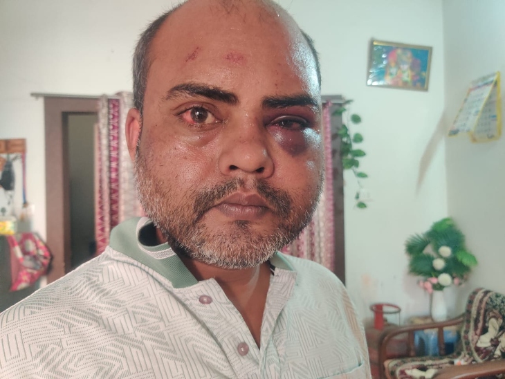 घायल पंकज सिंह, जिससे बदमाशों ने मारपीट की थी।