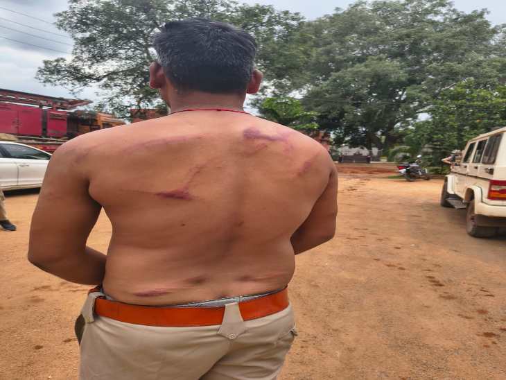 ग्रामीणों के मारपीट से वनकर्मी के शरीर चोट के निशान दिख रहे हैं।