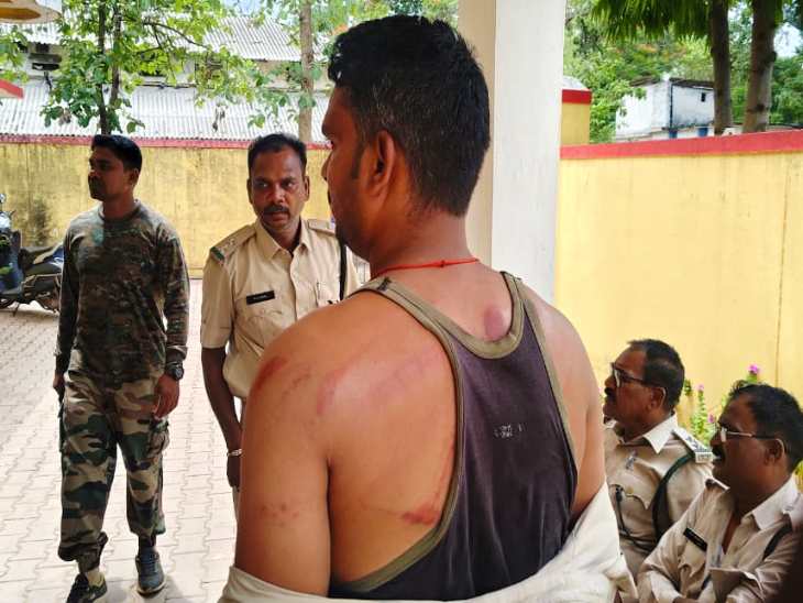 ग्रामीणों के मारपीट से वनकर्मी के शरीर चोट के निशान दिख रहे हैं।