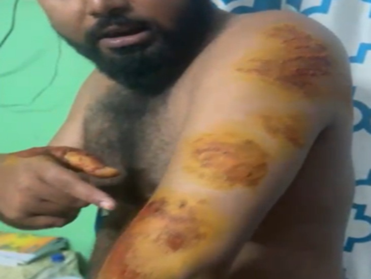 जख्म के निशान दिखाते पीड़ित विशाल।