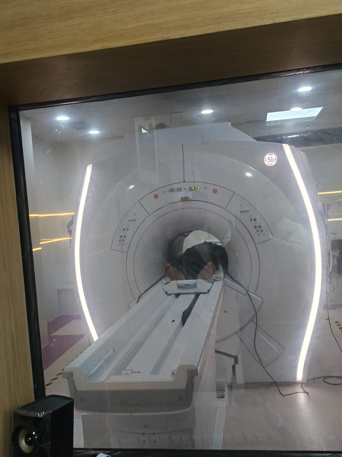 हमीदिया अस्पताल में नई MRI-CT स्कैन का ट्रायल किया गया।