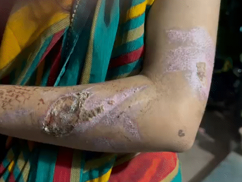 शारदापुर की रहने वाली रितु तिवारी के हाथों में गंभीर चोट के निशान हैं।
