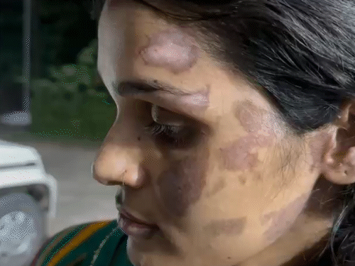 रितु तिवारी के चेहरे पर कई जगह चोट के निशान हैं। चेहरे को गर्म पानी से जलाया गया है।