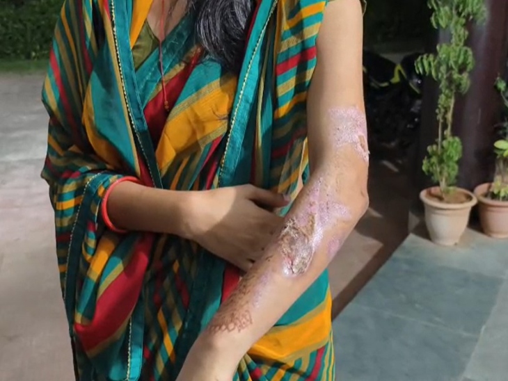महिला के दांए हाथ जलाया दिया है। बांह में भी गंभीर चोट के निशान हैं।