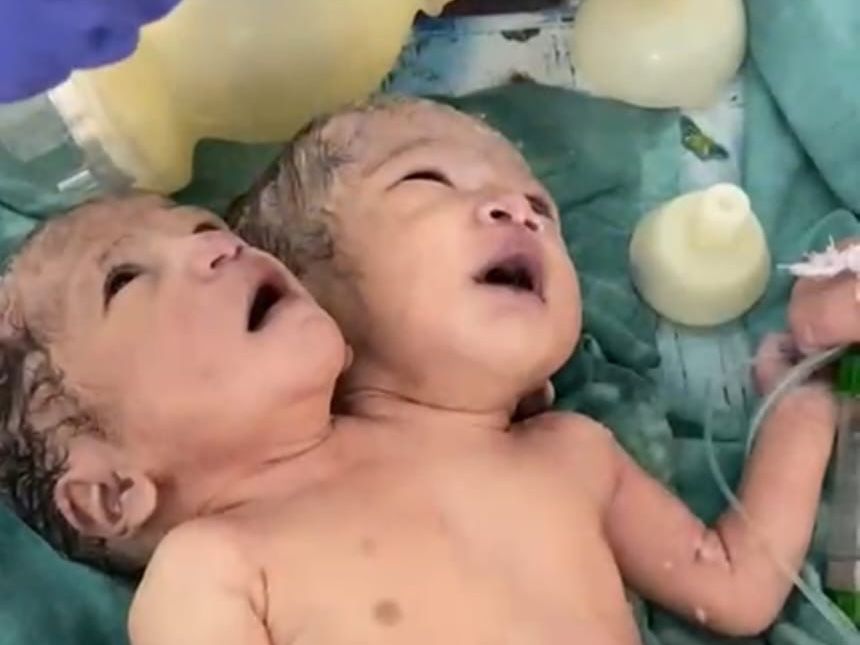 बच्ची फिलहाल MTH अस्पताल के सिक न्यूबॉर्न केयर यूनिट (SNCU) में भर्ती है।
