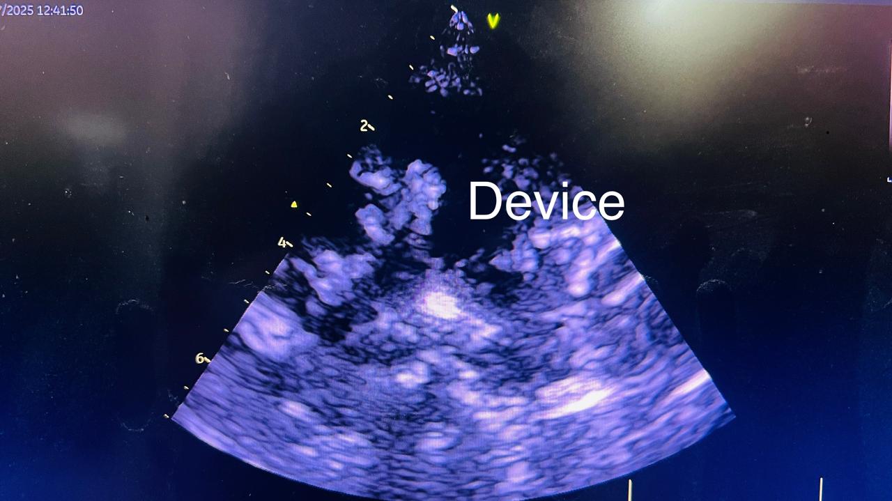 MDM हॉस्पिटल के कार्डियोलॉजी विभाग के डॉक्टरों ने सफल ऑपरेशन किया।