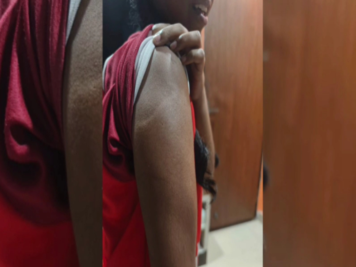 महिला टीचर ने छात्रा को छड़ी से पीटा, इससे छात्रा के हाथ में सूजन आ गई।