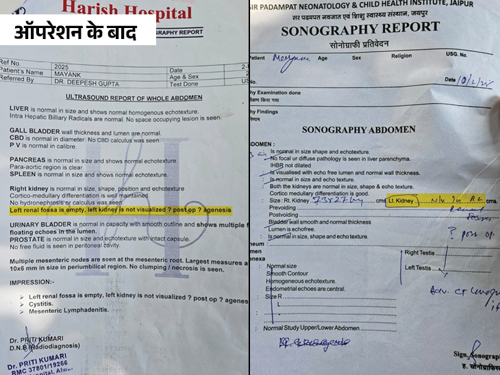 ये रिपोर्ट ऑपरेशन के बाद की है। जहां रिपोर्ट में लेफ्ट साइड की दोनों किडनियां नहीं है।