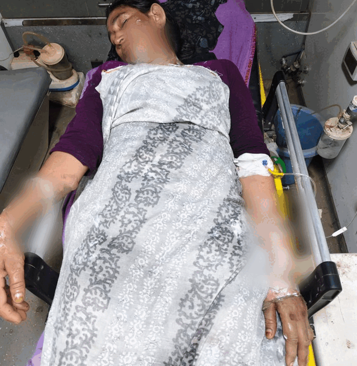 महिला का मुंह और हाथ-पैर बुरी तरह से झुलसे हैं। उसकी हालत नाजुक बनी हुई है।