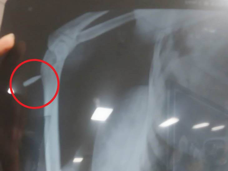 जोधपुर के एमडीएम अस्पताल में घायल छात्रा रेणू विश्नोई की कोहनी का एक्स-रे, जिसमें गोली साफ दिखाई दे रही है।