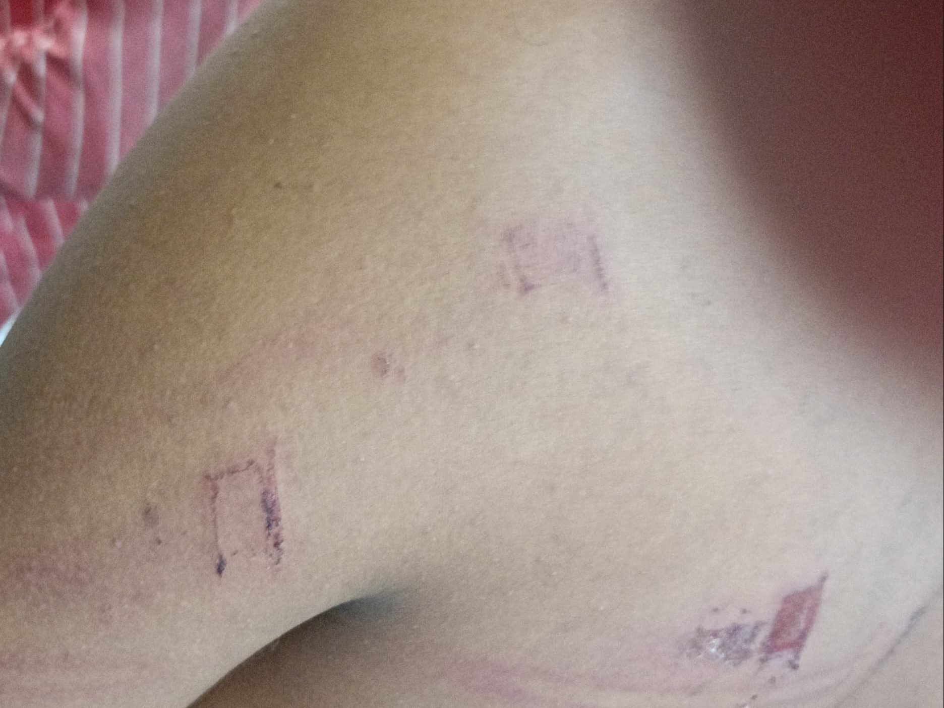 छात्रों के शरीर पर चोटों के निशान हैं।