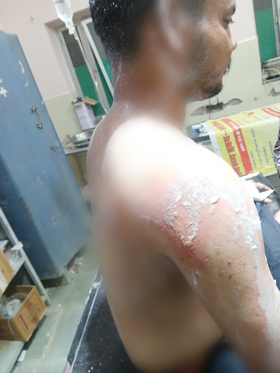 गोपाल सोनी पर छोटे भाई विनोद ने बालकनी से तेजाब की बोतल फेंककर मारी। ज्वेलरी के काम में इस तेजाब का इस्तेमाल किया जाता है।