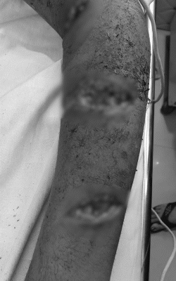 The girl is cut with a knife at 3 places on her hand. Up to 2 inches of meat came out in the attack.