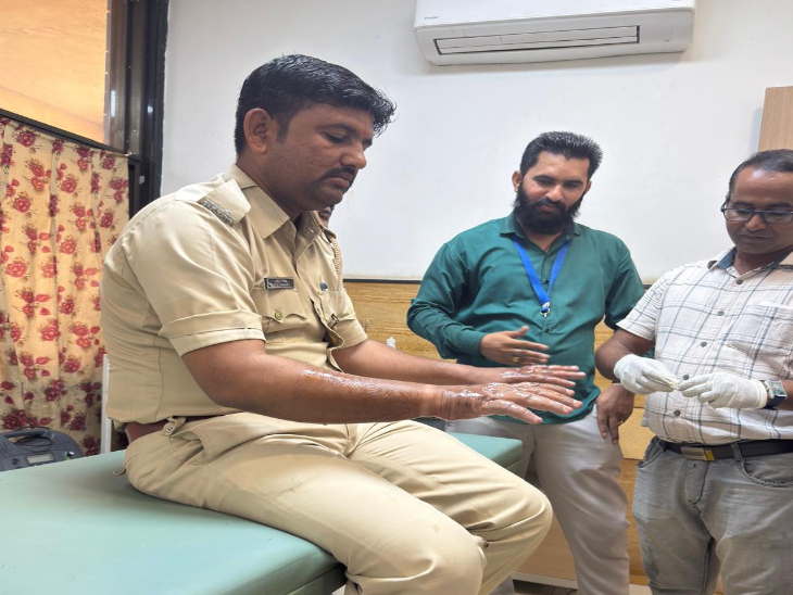कॉन्स्टेबल खीमसिंह के तेजाब से जले हाथ।