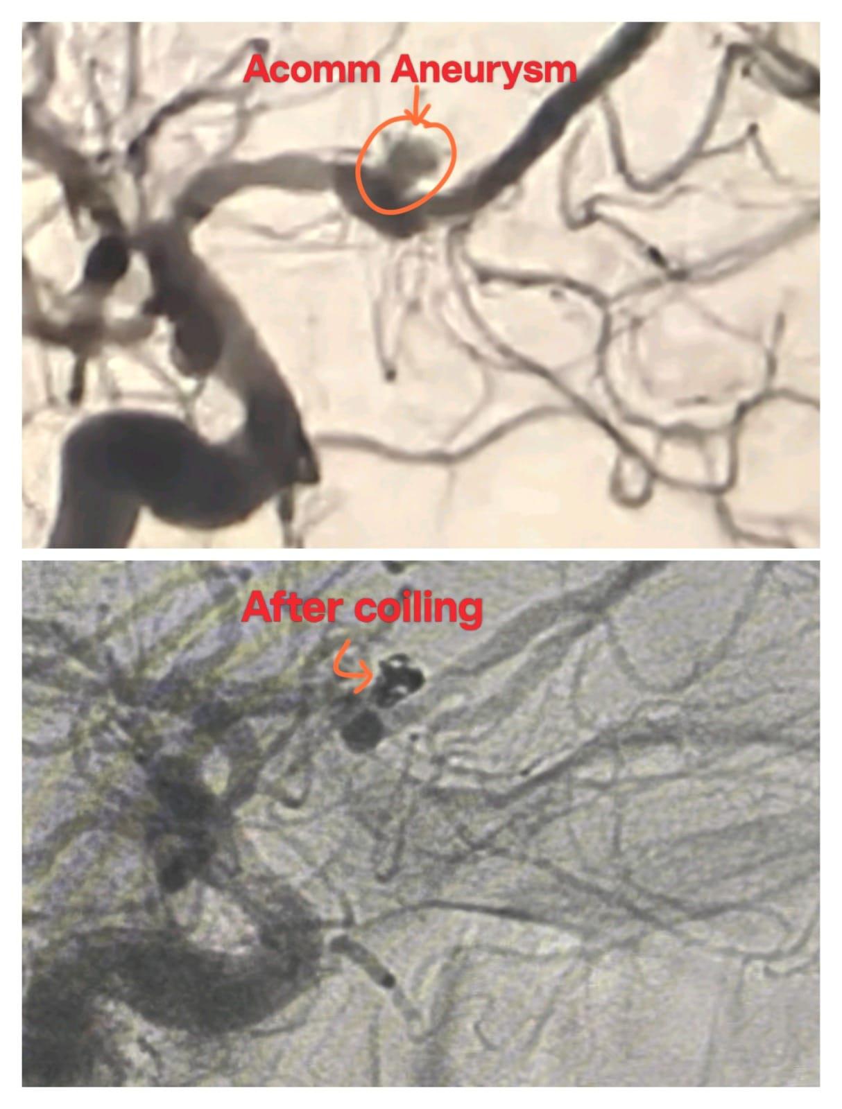 First ever endovascular neuro-interventional procedure performed at SNMC
