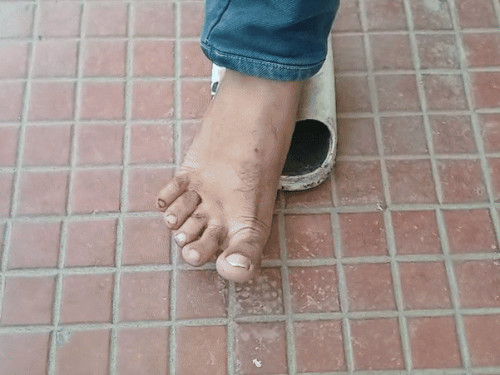 Shopkeeper Lalit Bajaj shows the dog bites.